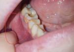 Опухла десна и боль в зубе фото 1