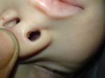 Шишки в носу у ребенка фото 1