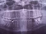 Болит зуб при нажатии фото 2