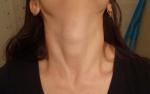 Давящие ощущения в щитовидке, шарики над кадыком, плаксивость фото 1