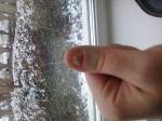 Белые пятна на ногте, отслока ногтевой пластины фото 1