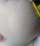 Пупырышки у грудного ребенка на лице фото 3