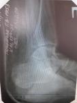 Косой перелом диафиза малоберцовой кости или нижней части лодыжки фото 4