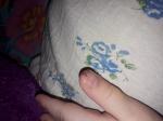 Темные пятна на пальце руки с волдырями у ребенка фото 3