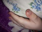 Темные пятна на пальце руки с волдырями у ребенка фото 2