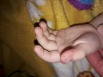 Темные пятна на пальце руки с волдырями у ребенка фото 1