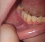Проблемы после удаления зуба с периодонтитом фото 1