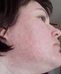 Сыпь на лице, постоянное ухудшение в течение года фото 3