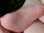 Повторная сыпь у ребёнка 7 лет на руках и ногах фото 3