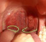 Вопрос о состоянии и необходимости удаления нёбных миндалин фото 1