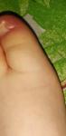 Опухоль на пальце ноги у ногтя фото 1