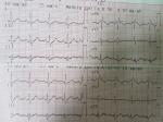 Здравствуйте, помогите расшифровать кардиограмму фото 1
