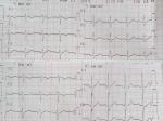 Здравствуйте, помогите расшифровать кардиограмму фото 2
