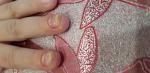 Утолщение и видоизменение ногтей, быстрый переход на другие ногти фото 2