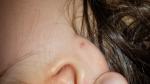 Красные пятна на мочке уха у ребенка фото 3