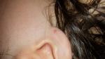 Красные пятна на мочке уха у ребенка фото 2