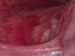 Налет или гной на язычной миндалине фото 2
