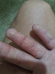 Шелушение и трещины пальцев рук у ребенка фото 2