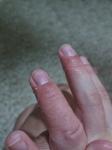 Шелушение и трещины пальцев рук у ребенка фото 3