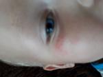 Сыпь у ребенка под глазом фото 3