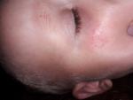 Сыпь у ребенка под глазом фото 2