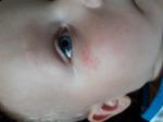 Сыпь у ребенка под глазом фото 1