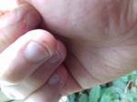 Коричневое пятно на пальце руки ниже ногтя фото 1