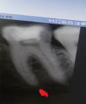 Боль после лечения зуба и установки штифта фото 1