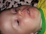 Аллергия на лице у ребенка фото 1