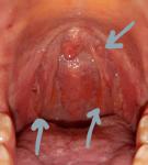 Горло красное, наросты фото 1