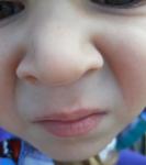 Точки на носу у ребенка фото 2