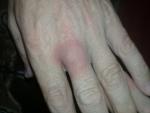 Воспаление среднего пальца на левой руки. Причина? фото 1