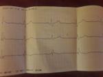 Поможете расшифровать ЭКГ? фото 1