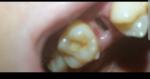 Лунка после удаления зуба фото 3