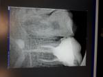 Боль в зубе с удаленными нервами фото 1