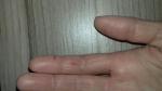 Трескается кожа на пальцах рук зимой фото 1
