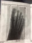 Артрит суставов правой стопы, как лечить, какой диагноз? фото 1