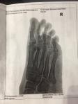 Артрит суставов правой стопы, как лечить, какой диагноз? фото 2