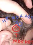 Образования на волосяной части головы фото 1
