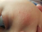 Ребенку 9 лет на лице появились пупырки или волдыри без жидкости фото 1