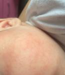 Атопический дерматит или что-то другое у младенца? фото 1