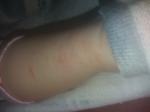 Непонятные плотные пятна на ноге у ребенка 1 год фото 2