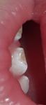 Гипоплазия эмали на молочных зубах фото 1