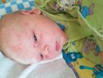 Высыпания у новорожденного на лице помогите фото 3