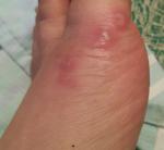 Красные пятна на пальце ноги фото 1