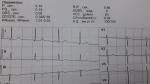 Скачки давления, расшифровка кардиограммы фото 2