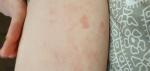 Красные пятна и сниженный иммунитет фото 2