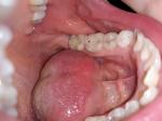 Черные точки на зубах после пломбирования фото 1