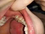 Черные точки на зубах после пломбирования фото 3