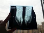После операции на косточку, большой палец принял вздернутое положение фото 2